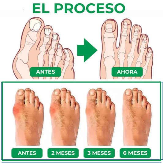 Hallux Relief™-¡Potencia tu tratamiento y alivia el dolor más rápido!